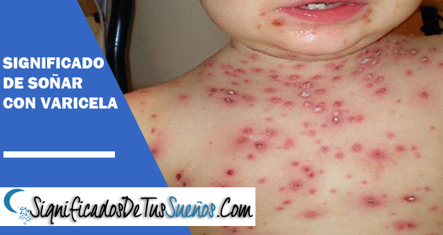 Significado de soñar con varicela