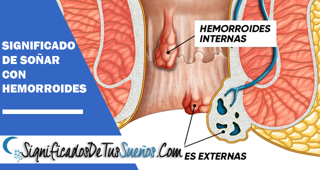 Significado de soñar con hemorroides